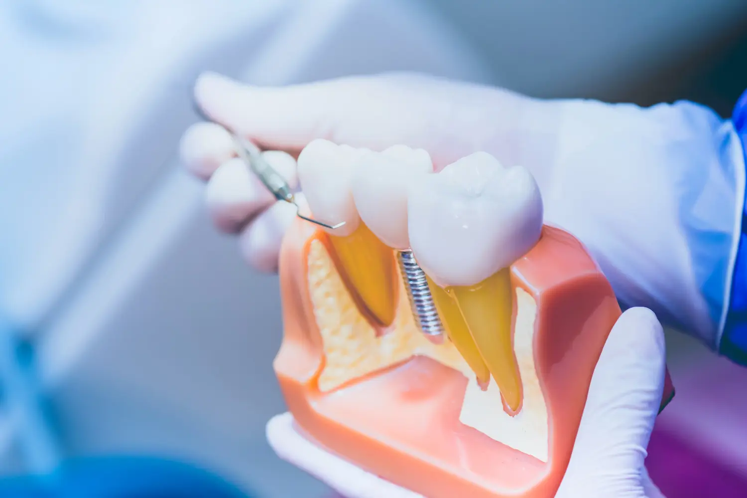 Modelo anatómico de una boca durante un procedimiento dental, donde un dentista utiliza un instrumento sobre un diente y se observan implantes dentales en el hueso de la mandíbula